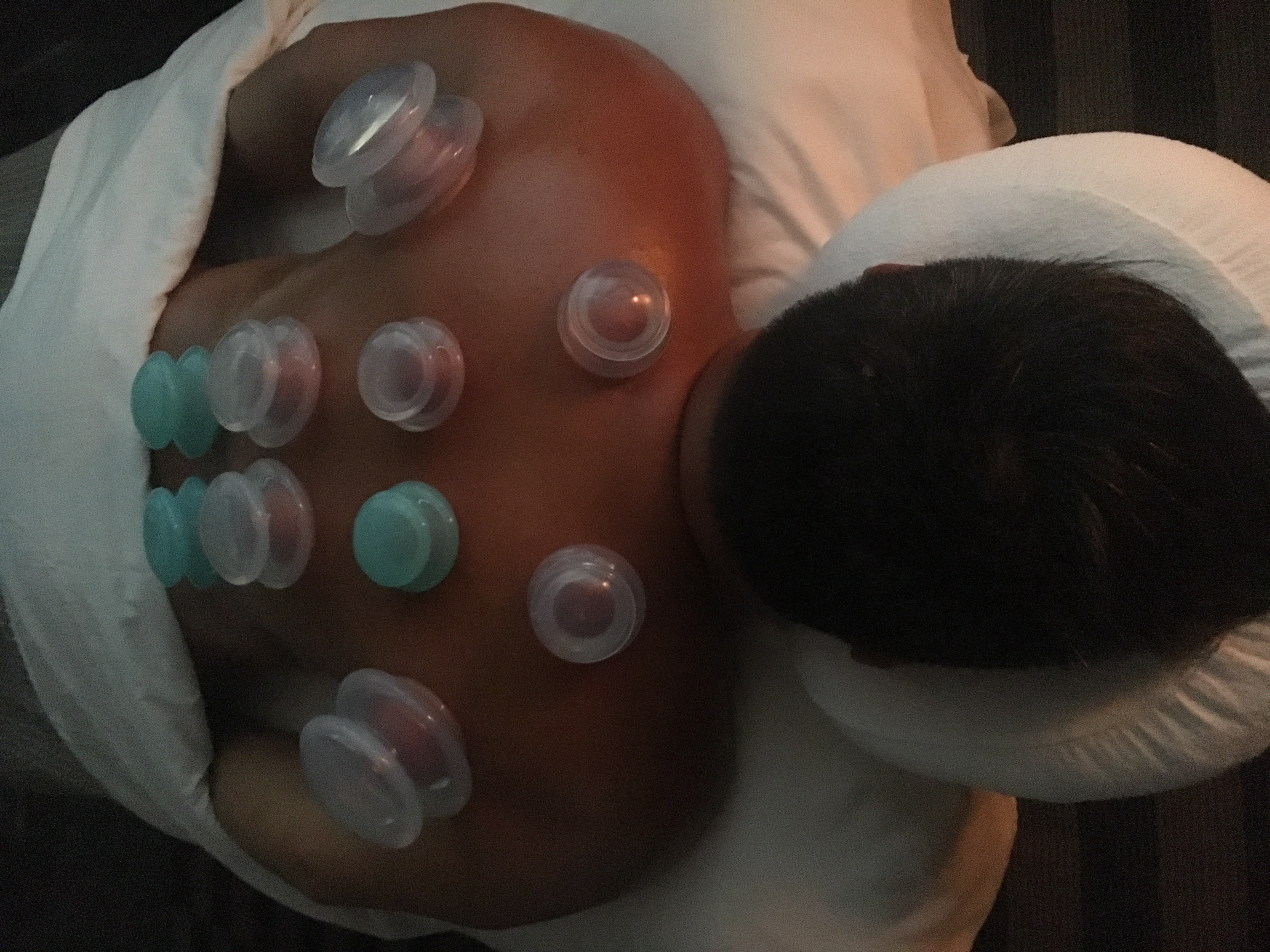 client receiving massage cupping at urban oasis in nashville