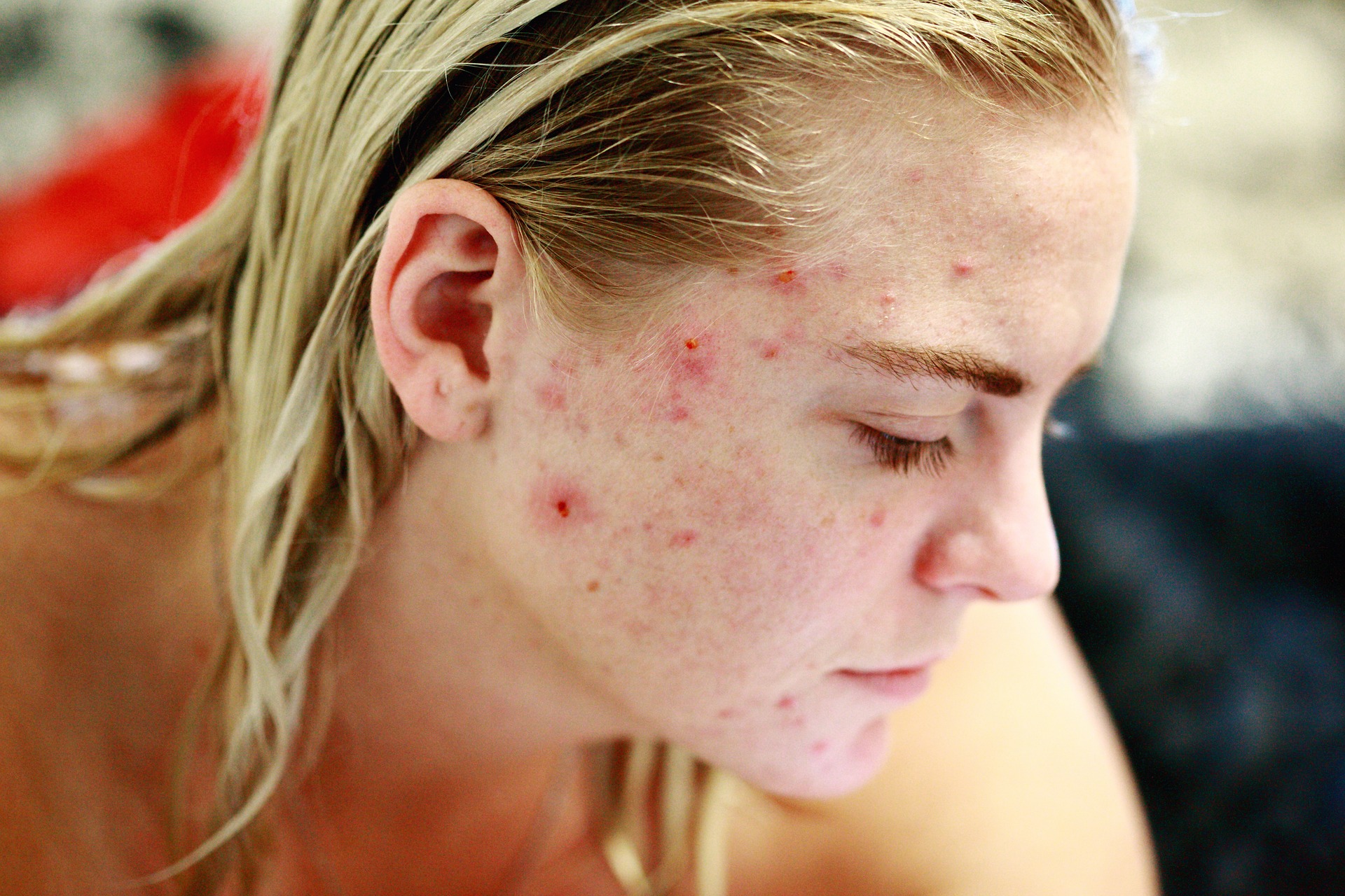 Woman with painful, red, and open sore acne on the side of her face