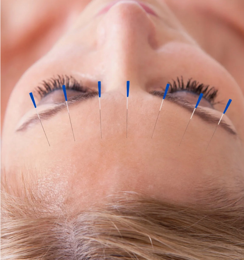 Women getting acupuncture therapy treatment on forehead