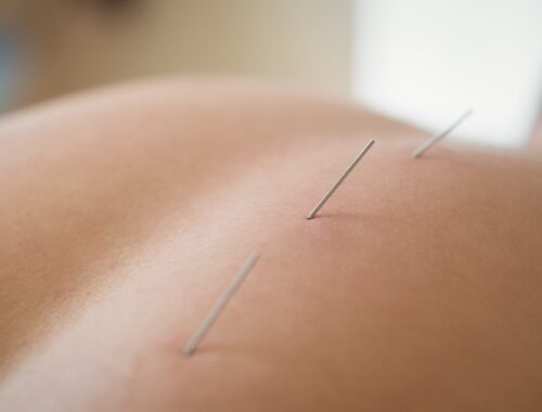 Acupuncture points that are situated in all areas of the body.