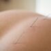 Acupuncture points that are situated in all areas of the body.